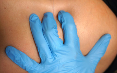 What is Dry Needling?